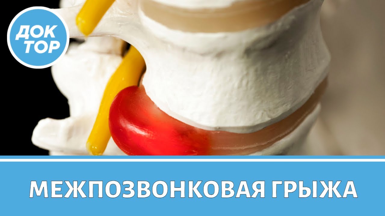 Межпозвонковая грыжа: удалять или нет