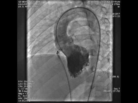 Antegrade route perimembranous VSD device closure without forming an arteriovenous (AV) loop