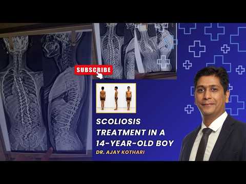 Scoliosis Treatment in a 14-Year-Old Boy | Dr. Ajay Kothari