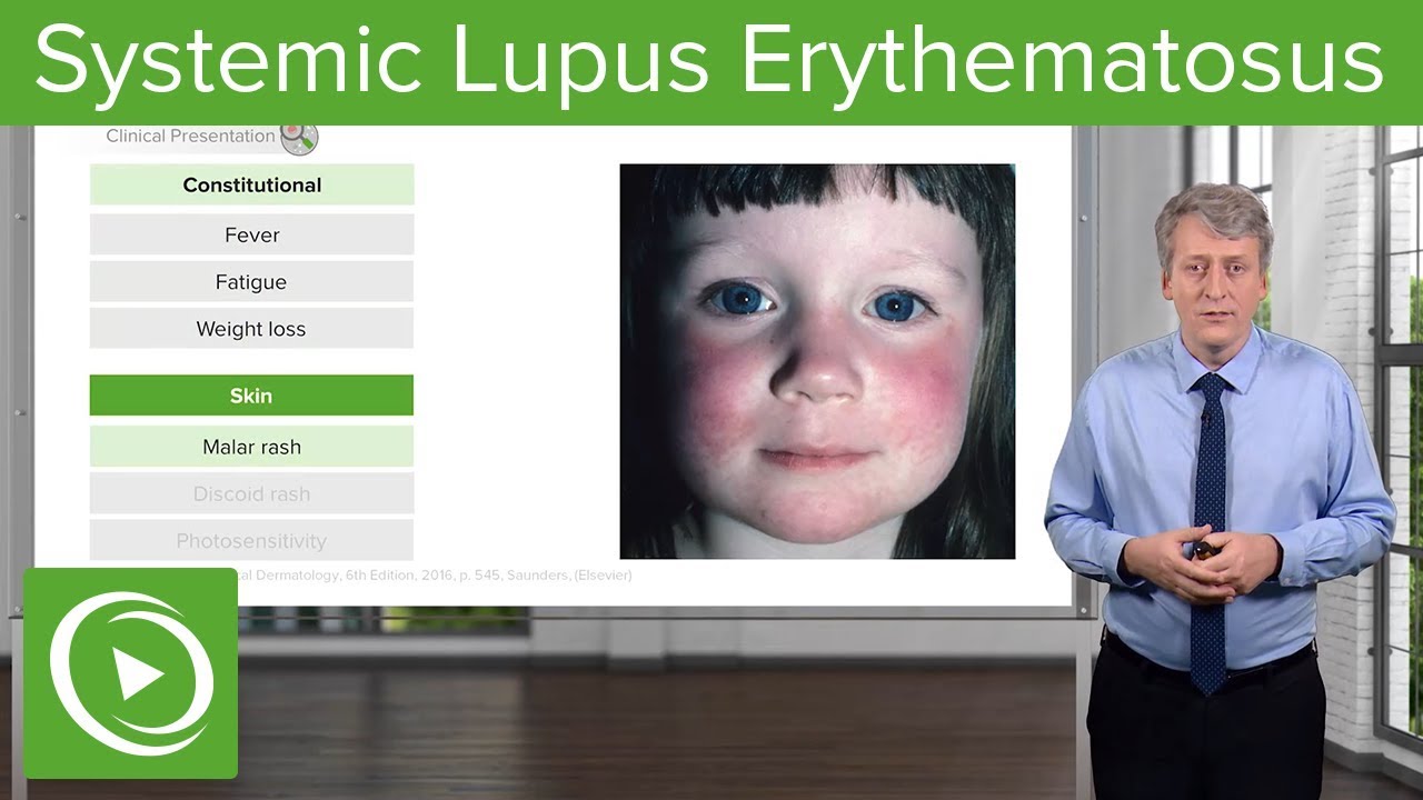 Systemic Lupus Erythematosus (SLE) in Children – Pediatrics | Lecturio