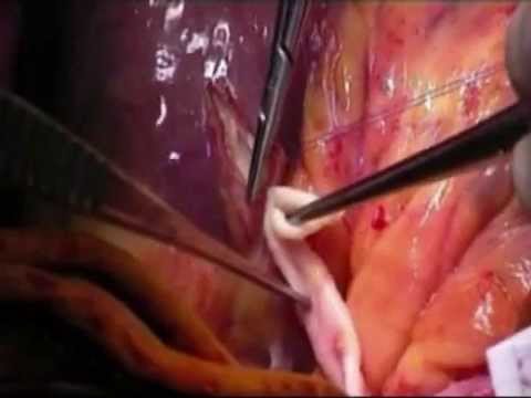 Trattamento della malattia degenerativa del disco, nella località termale Raduga Ufa Esercizio Video per colonna cervicale