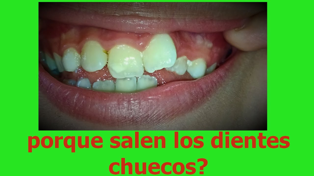 COMO SABER si a tu hijo le saldran LOS DIENTES CHUECOS!