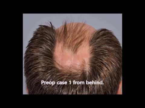 Superb hair after hair transplant in Washington by Dr. Lindsey | McLean | VA | MD | DC thumbnail