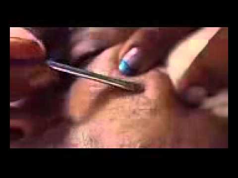 blackhead