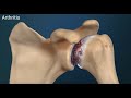 Total Shoulder Replacement