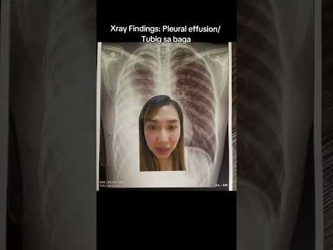 Xray findings: Pleural effusion o tubig sa baga