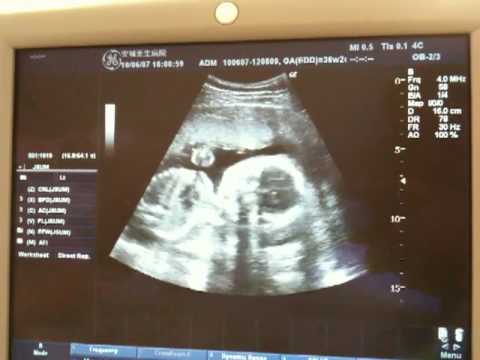 Caçulinha com 23 semanas