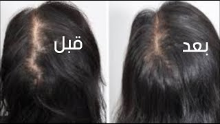 9 أساليب فعّالة لإعادة نمو الشعر بشكل طبيعي والتخلص من الفراغات بين بصيلاته 9 أساليب فعّالة لإعادة نمو الشعر بشكل طبيعي والتخلص من الفراغات بين بصيلاته