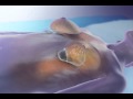 Breast Augmentation