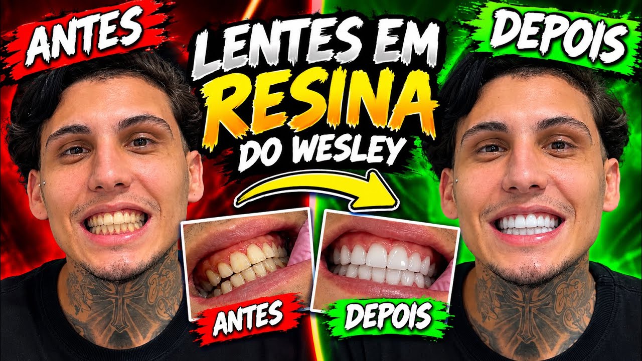 PAGUEI 2000R$ PARA COLOCAR LENTE NOS DENTES DO ZÉ DO ROLO 
