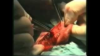 preview picture of video 'Otoplasty,Ear pinning surgery Live!. dr.Besnik Bardhi. Operimi estetik i laprave te vesheve llapush.'