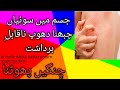 Jism Me Soiyan Chubhna Prickl Cholinergic Urticaria Dr Hafiz Dr Hafiz Abdul Sattar Anjum Urdu Hindi