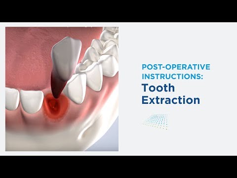 Post-Op: General Extraction in Modesto CA | Greater Modesto Dental Implant & Oral Surgery Center