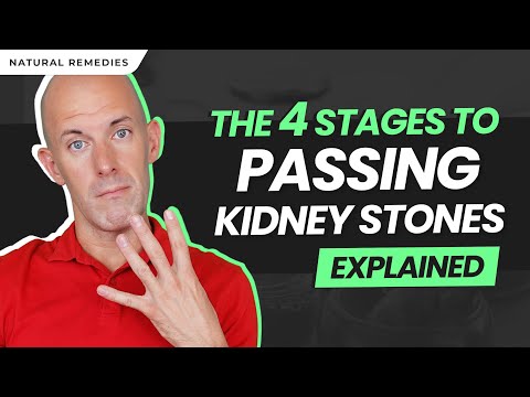 4 Stages to Passing Kidney Stones