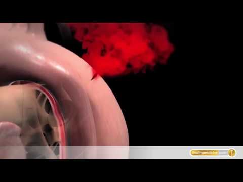 Aortenaneurysma: Entstehung, Dissektion und Ruptur