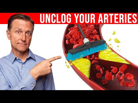 The #1 Best Remedy to Clean Plaque From Your Arteries