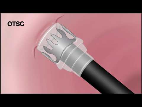 HCC 1472-Lesson-11a2 -Hemostatic Devices-Over the Scope Clips