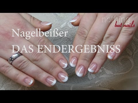 Die Behandlung des Anbruches auf den Nägeln gribka der Nägel Warum gehen die Nägel von der Haut auf den Händen die Behandlung weg