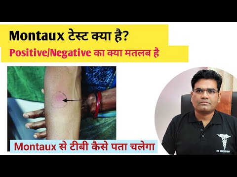 What is the Montaux test? When does the Montaux test come back positive? | TB detection test