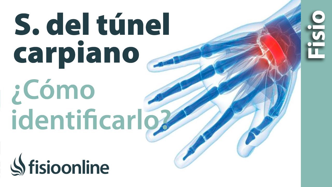 Cómo saber si tienes el síndrome del túnel carpiano