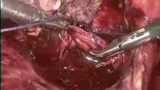 Empyema Gall Bladder –Laparoscopic Cholecystectomy