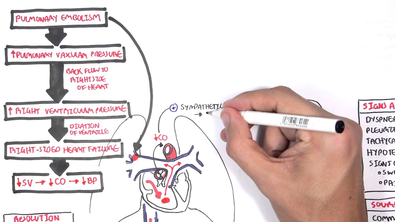 Pulmonary Embolism PART I (Overview)