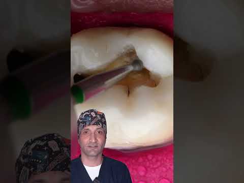 Never Ignore If Your Molar Teeth Look Like This #satisfying