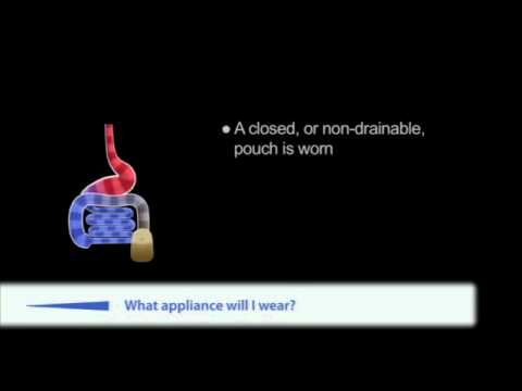 A guide to a colostomy