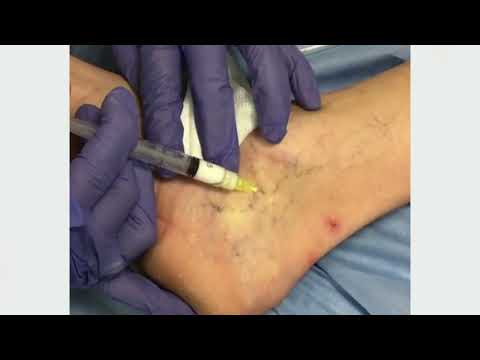 Escleroterapia con espuma por Dermatólogo en Cali la Dra. Silvia Perafán