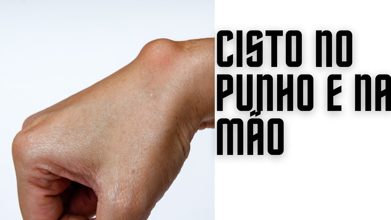 Cisto no punho e na mão