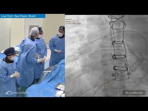 Minimalistic Approach With Transcatheter, Bicaval Valves System for Severe Tricuspid Regurgitation