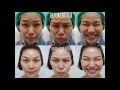 โบท็อก หน้า เรียว