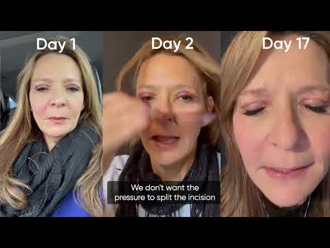 Advanced Answers - 5 Things To Avoid Following Upper Blepharoplasty Surgery (Upper Eyelids) 2023