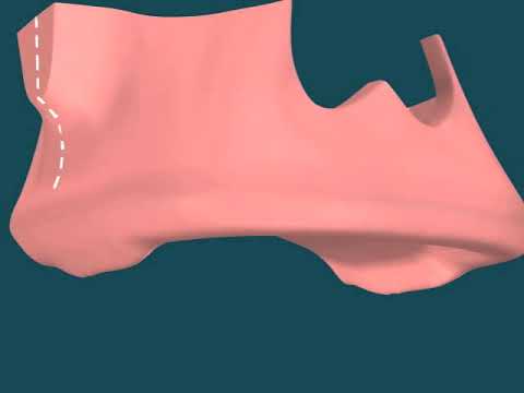 Dental Video of Maxillary Tuberosity Removal