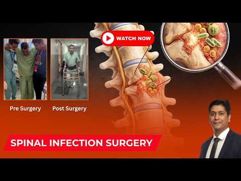 Spinal Infection Treatment & Recovery Explained | Dr. Ajay Kothari | Spinal Infection Case