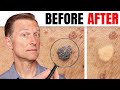How To Remove Skin Tags And Warts Overnight Dr Berg Explains
