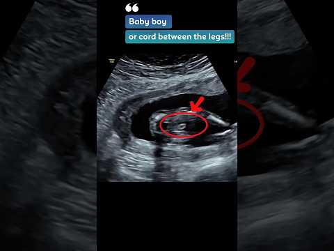 Baby boy or umbilical cord between the Legs | 15 weeks ultrasound #shorts
