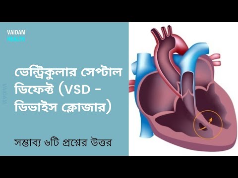 ভেন্ট্রিকুলার সেপটাল ডিফেক্ট (ভিএসডি) - ৬ টি প্রায়শই জিজ্ঞাসিত প্রশ্ন