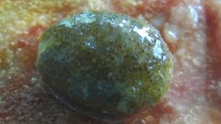 Watch Inside Of Gall bladder - Stone Removed