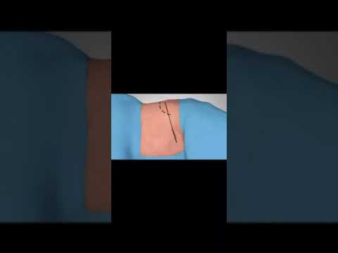 Minimally Invasive Lateral Anterior Lumbar Interbody Fusion (ALIF)