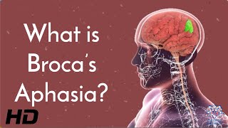 Broca&#39;s Aphasia and the Brain: What We Know and What We&#39;re Still Learning