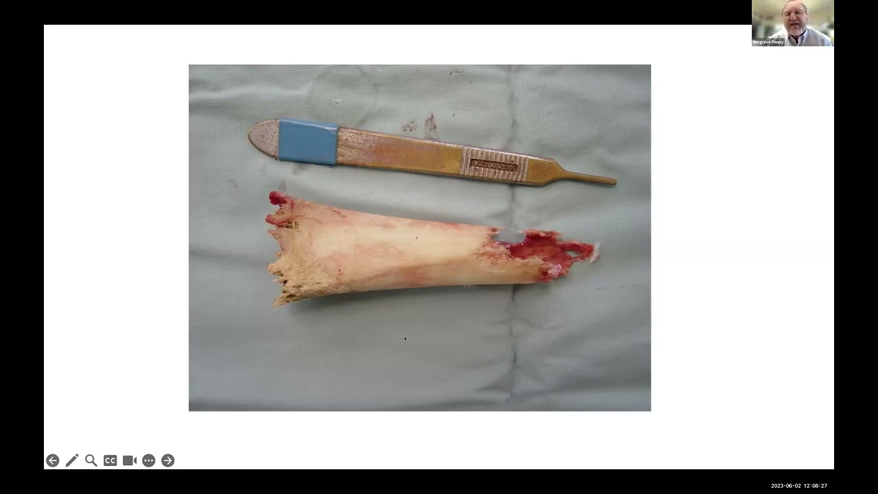 Session 15: Congenital, Developmental, Post Traumatic, Post Infectious Lower Limb Deformity Cases