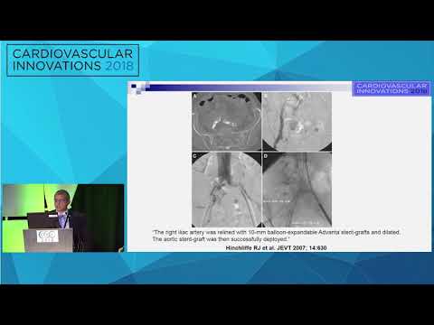 CVI2018 Session: How to manage nondilatable heavily calcified iliacs - Nicolas Shammas, MD