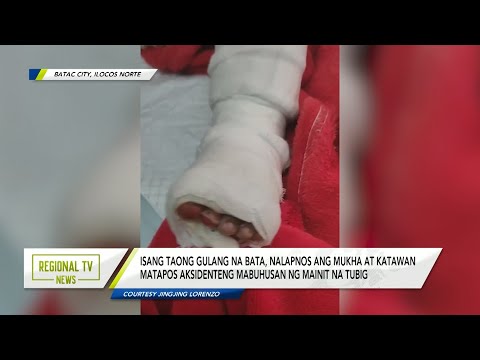 Regional TV News: Isang taong gulang na bata, nalapnos ang mukha at katawan