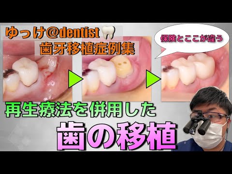 生命歯学科 【歯牙移植症例集】再生療法を併用した自由診療における歯の移植🦷保険の移植とココが違う！保険の歯牙移植との違いやそれによるメリットについて解説します！！
