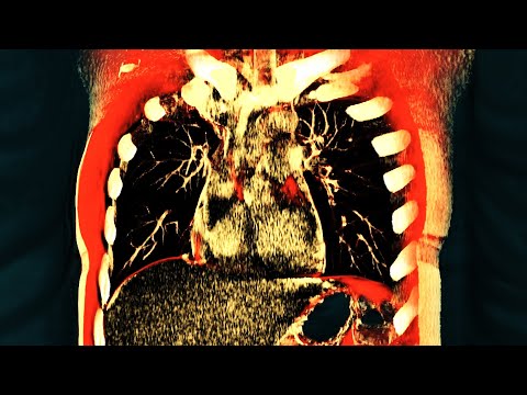 A Man Took Dinitrophenol DNP To "Lose Weight" And This Happened