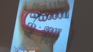 ¿Porqué reponer una muela perdida