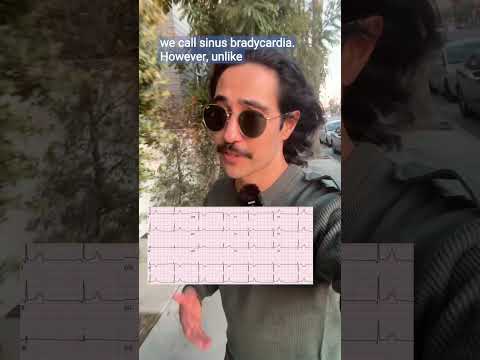 Heart Rate is Too Slow! Doctor Explains #bradycardia #cardiac #doctor