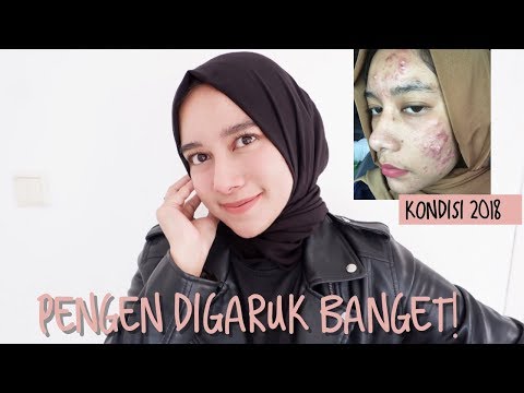 download lagu mp3 mp4 Cara Untuk Menghilangkan Jerawat Gatal, download lagu Cara Untuk Menghilangkan Jerawat Gatal gratis, unduh video klip Cara Untuk Menghilangkan Jerawat Gatal