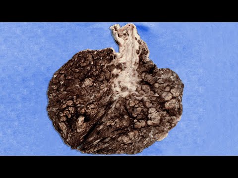 A Dad Ate 25 Packs Silica Gel For Breakfast. This Is What Happened To His Stomach.